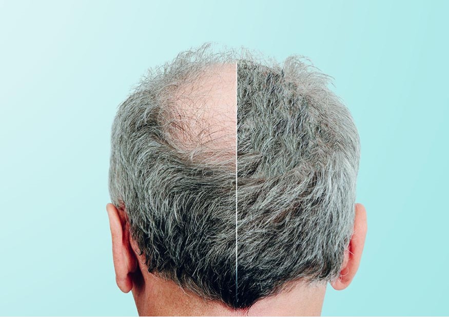 5-tips-for-hair-transplant-before-and-after-results-that-dont-disappoint